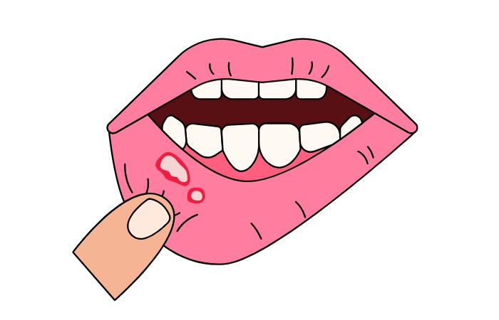 Truth abt mouth ulcers